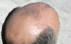 what-causes-baldness